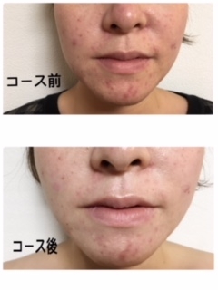 30代 角質ケアでニキビも改善 ガサガサ肌の改善